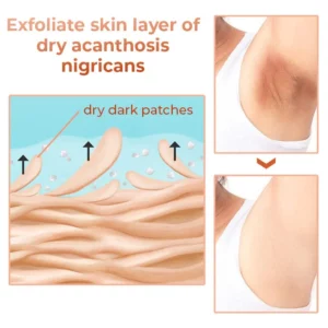 Alternative view of GFOUK™ Acanthosis Nigricans Relief Oil