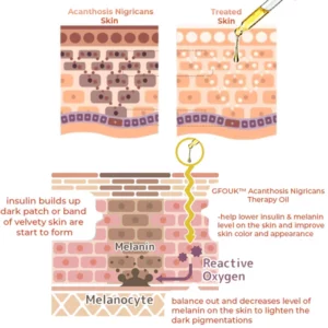 Alternative view of GFOUK™ Acanthosis Nigricans Therapy Oil
