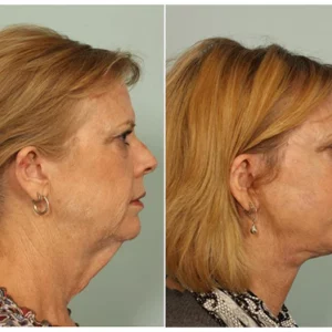 GFOUK™ EMSculpt V-Face Beauty Sleeping Device