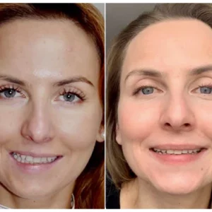 GFOUK™ EMSculpt V-Face Beauty Sleeping Device