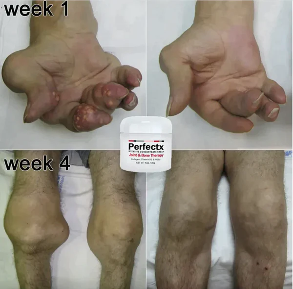 GFOUK™ Perfectx Gelenk- und Knochentherapie-Creme - Image 3