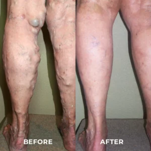 MEDix™ Vein Care Fading Spray