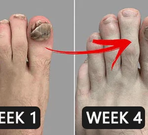 Alternative view of NailREBORN™ Antifungal - Professional Strength