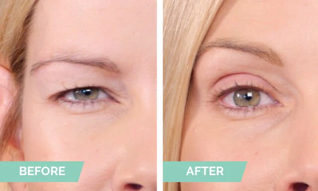 One® Natural Invisible Eyelid - Image 2