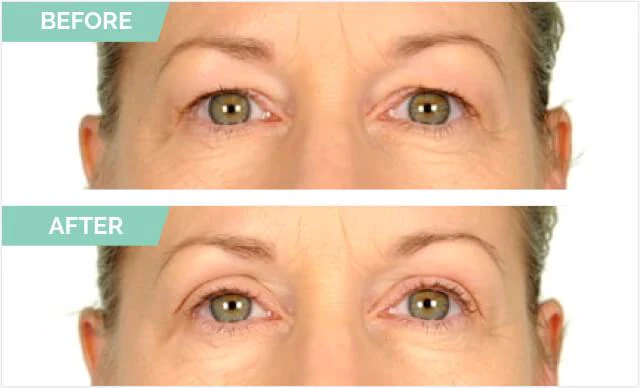 One® Natural Invisible Eyelid - Image 6