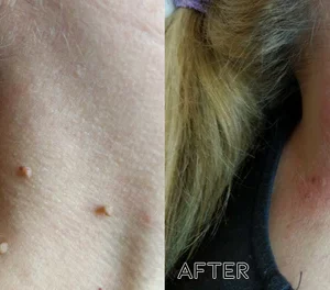 Oveallgo™ Advanced Skin Tag Clearing Essence
