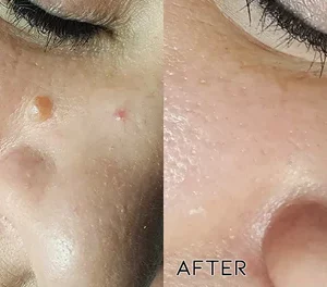 Oveallgo™ Advanced Skin Tag Clearing Essence