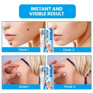 Oveallgo™ Maximum Performance Ointment for the Immediate removal of Warts