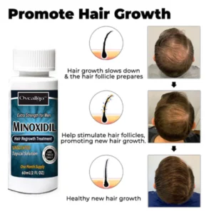 Alternative view of Oveallgo™ Minoxidil Hair Regrowth Treatment