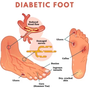 Oveallgo™ SugarDown Diabetes Foot Pads
