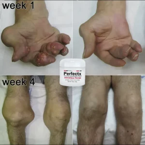Alternative view of Perfeᴄtx™ Jᴏint & Bᴏne Therapy Cream