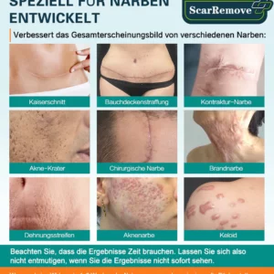 ScarRemove™ Fortgeschrittenes Narbenspray für alle Arten von Narben