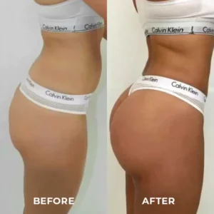 ShapeZ™ Buttock Lifting Instrument