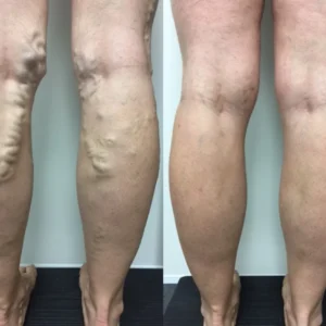 VeinCare VaricoseVein Healing Cream