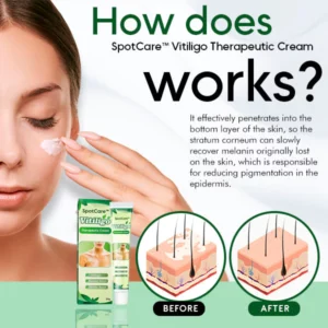 Vitiligo Therapeutic Cream