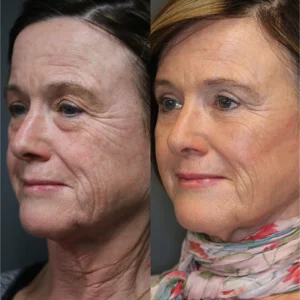 WRINKLEAWAY™ EYE OIL