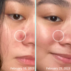 ACRēN™ Hydrocolloid Face Patches