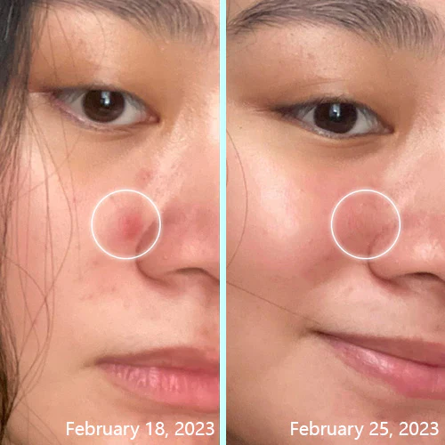 ACRēN™ Hydrocolloid Face Patches