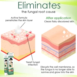 AEXZR™ Tinea Versicolor Cream