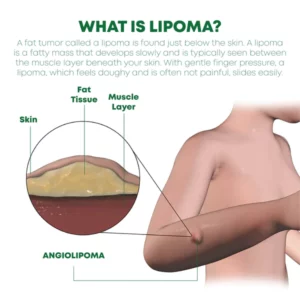 Alternative view of ATTDX LipomaRemoval Herbal Cream