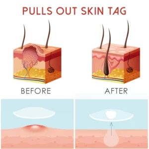 ATTDX SkinTag Remover HerbalPatches