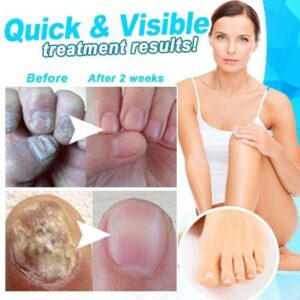 Anti-fungal Home Treatment Set
