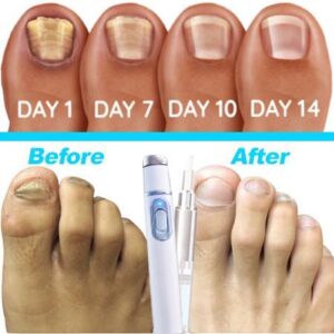 Anti-fungal Home Treatment Set