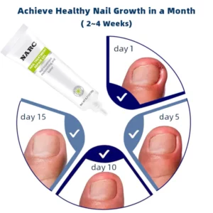 Best Selling NARC Removal Paronychia Gel