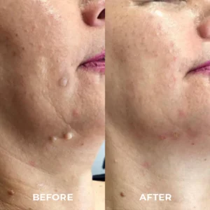 DR. Reilly™ Skin Tag Remover