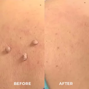 DR. Reilly™ Skin Tag Remover