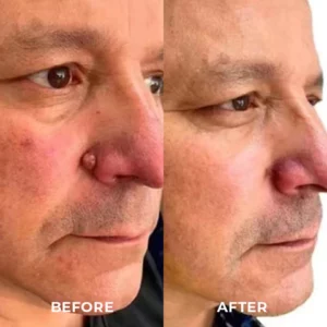 DR. Reilly™ Skin Tag Remover