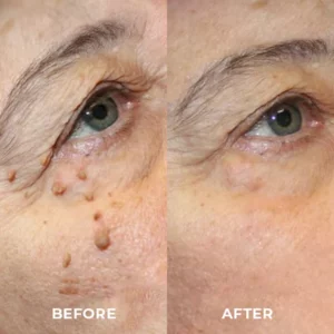 DR. Reilly™ Skin Tag Remover