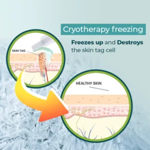 DR. Reilly™ Skin Tag Remover
