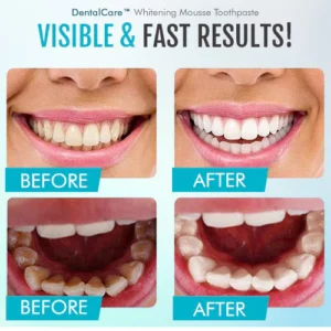 DentalCare™ Whitening Mousse Toothpaste