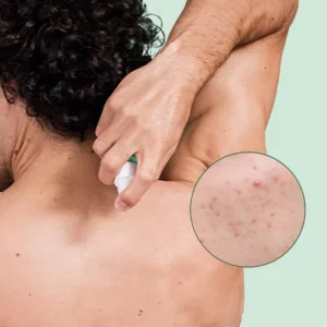 EELHOE™ Back Acne Treatment Spray