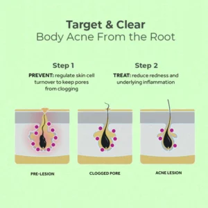 EELHOE™ Back Acne Treatment Spray