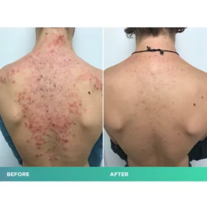 EELHOE™ Back Acne Treatment Spray