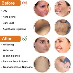 Fivfivgo™ Reinigungslotion für Akne & Pickel & Acanthosis Nigricans
