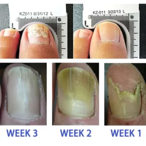 FootFree™ Antifungal - Professional Strength