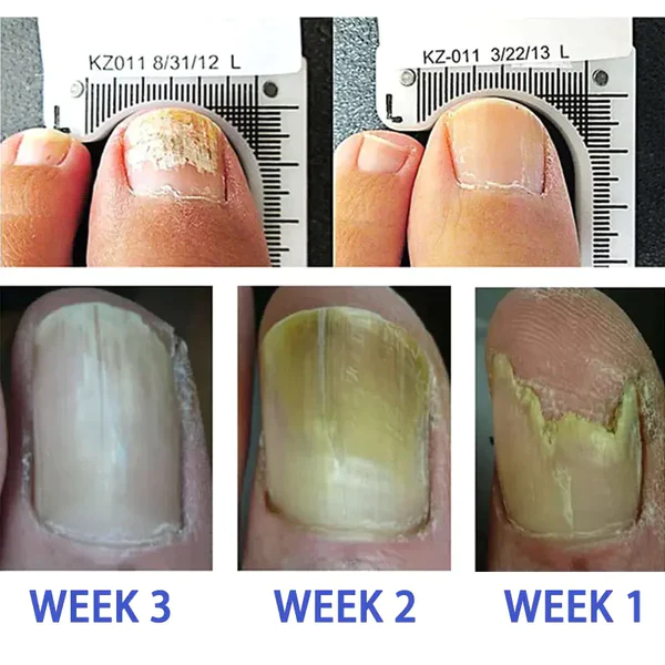 FootFree™ Antifungal - Professional Strength