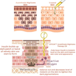 GFOUKTM Acanthosis Nigricans Therapy Oil