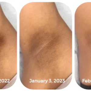 GFOUK™ AcanthoClear Therapy Spray