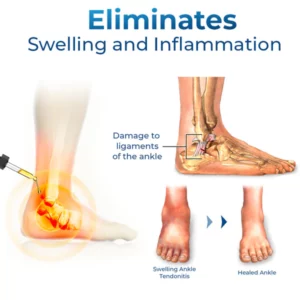GFOUK™ German Ankle Tendonitis Therapieöl