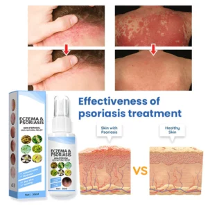 Herbal Psoriasis Relief Spray