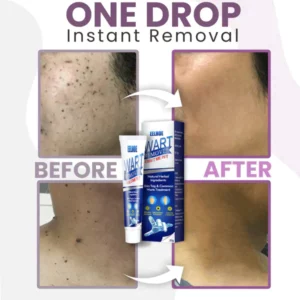 Instant Warts Removal Cream™