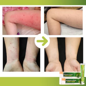 Intensive Eczema Relief Cream