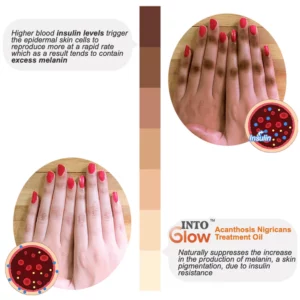 IntoGlow™ Acanthosis Nigricans Treatment Oil