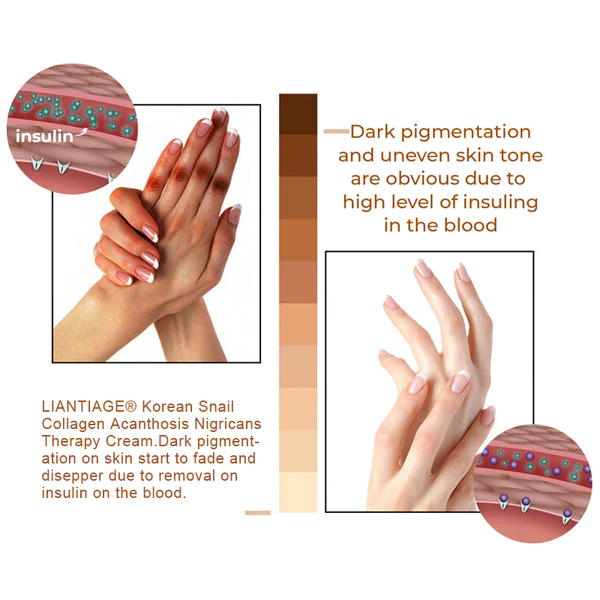 LIANTIAGE® Korean Snail Collagen Acanthosis Nigricans Therapy Cream - Image 6