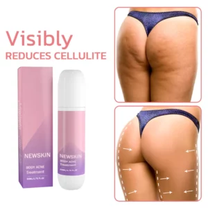NEWSKIN™ Pimple & Acne Treatment Roll On Serum