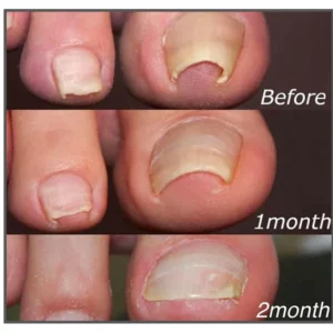 Nail Correction Patches